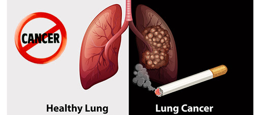 healthy & unhealthy lungs
