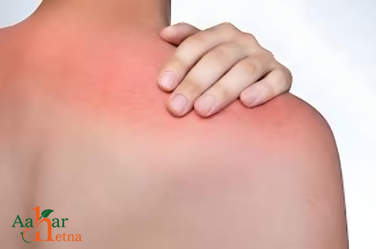 skin Burns