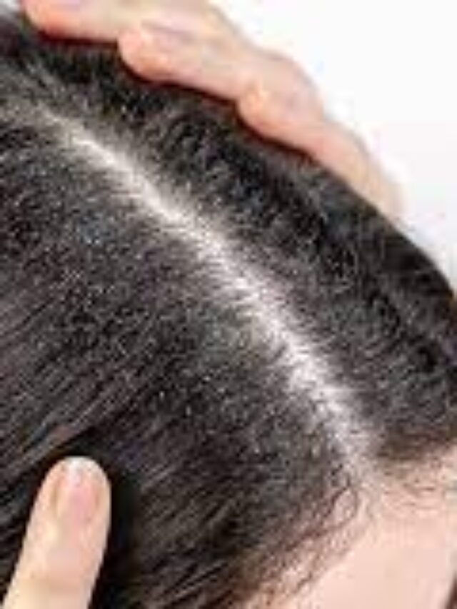 7 Ways to Get Rid of Dandruff In Winter