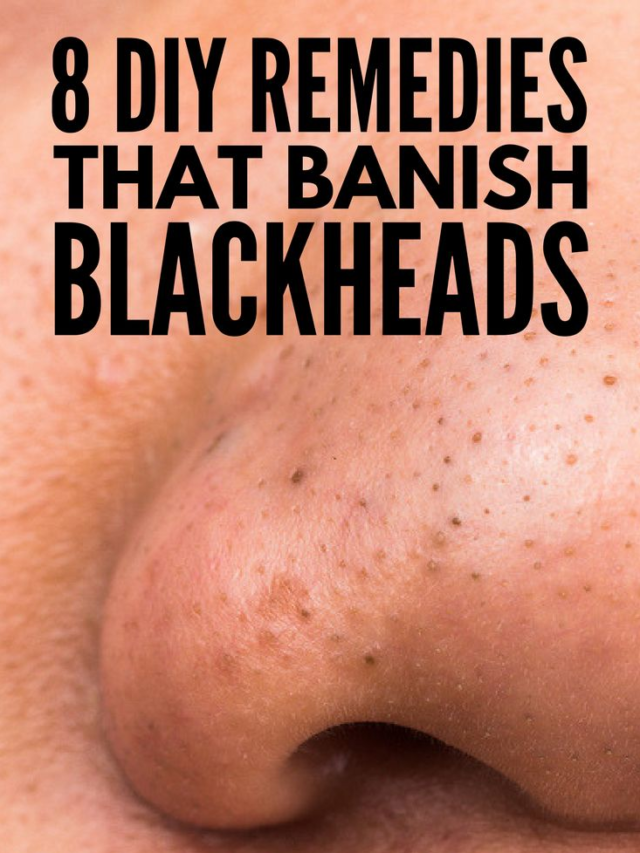 8 Ways to Remove Blackheads from Your Nose