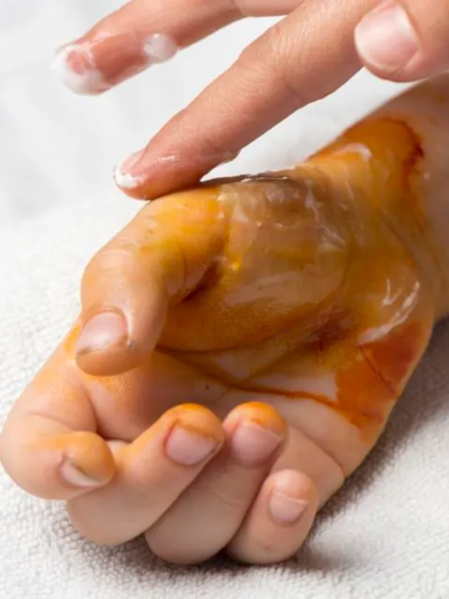 10 Home remedies for Burns