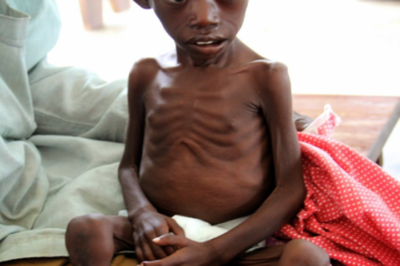 Symptoms of Marasmus in Hindi