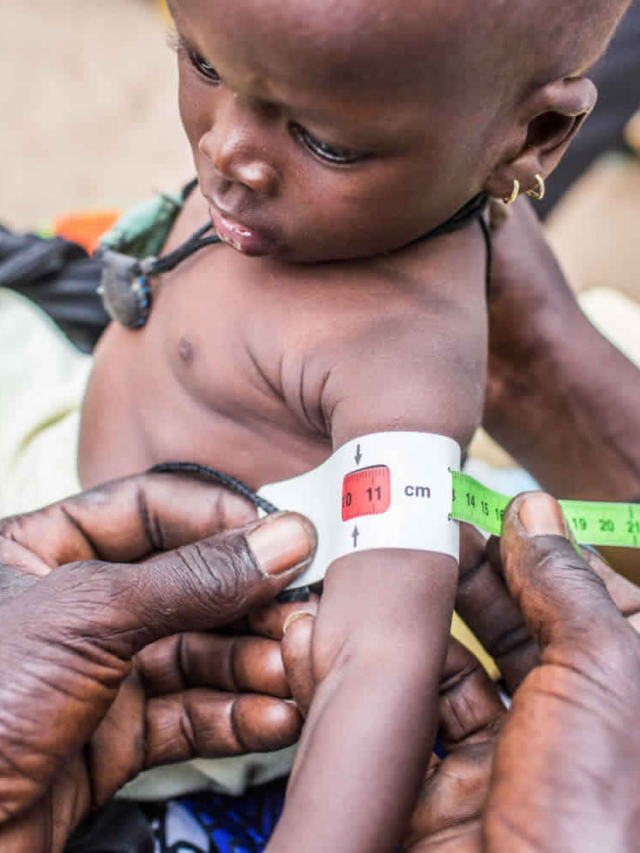 मरास्मस रोग के कारण और जोखिम कारक – Marasmus Causes and Risk factors in Hindi