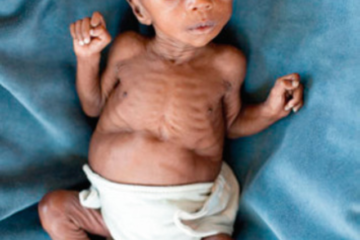 external signs of marasmu