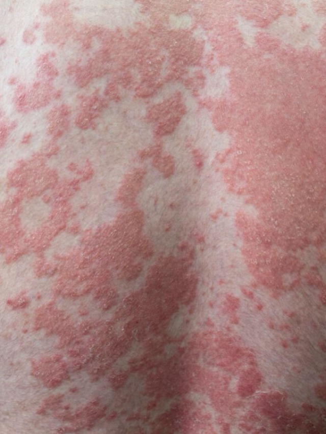 What Are Psoriasis Symptoms? What Does Psoriasis Look Like?