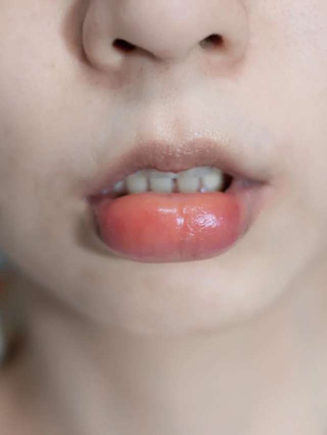 होंठों में सूजन आने के कारण – Causes Of Swollen Lips In Hindi