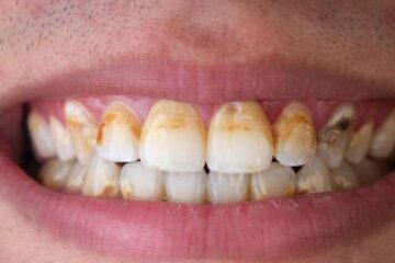 cropped-tartar-buildup-on-teeth.jpg